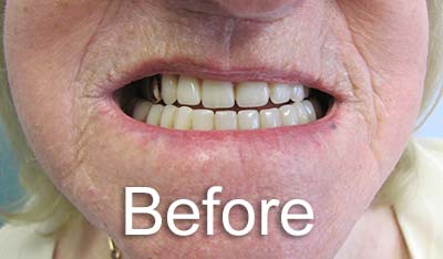 Case Study - Theresa before treatment