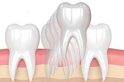 tooth-extractions-services North Street Dental services - tooth extractions